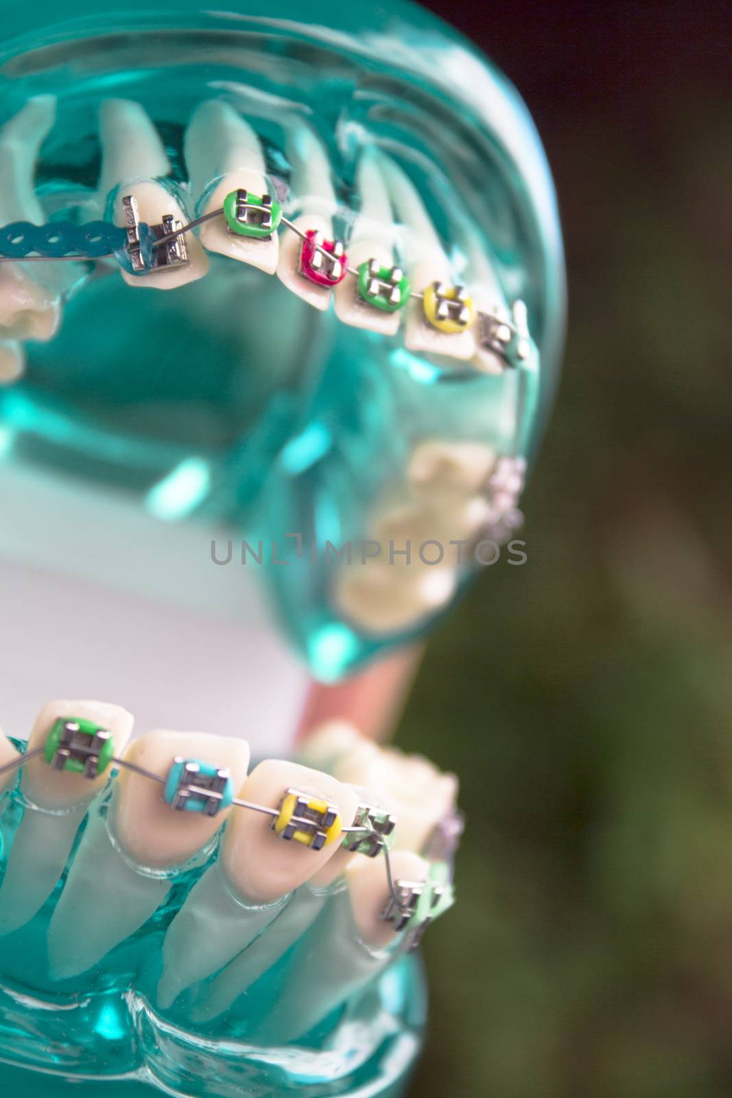 Classic dental metal orthodontics with colored hooks by GemaIbarra