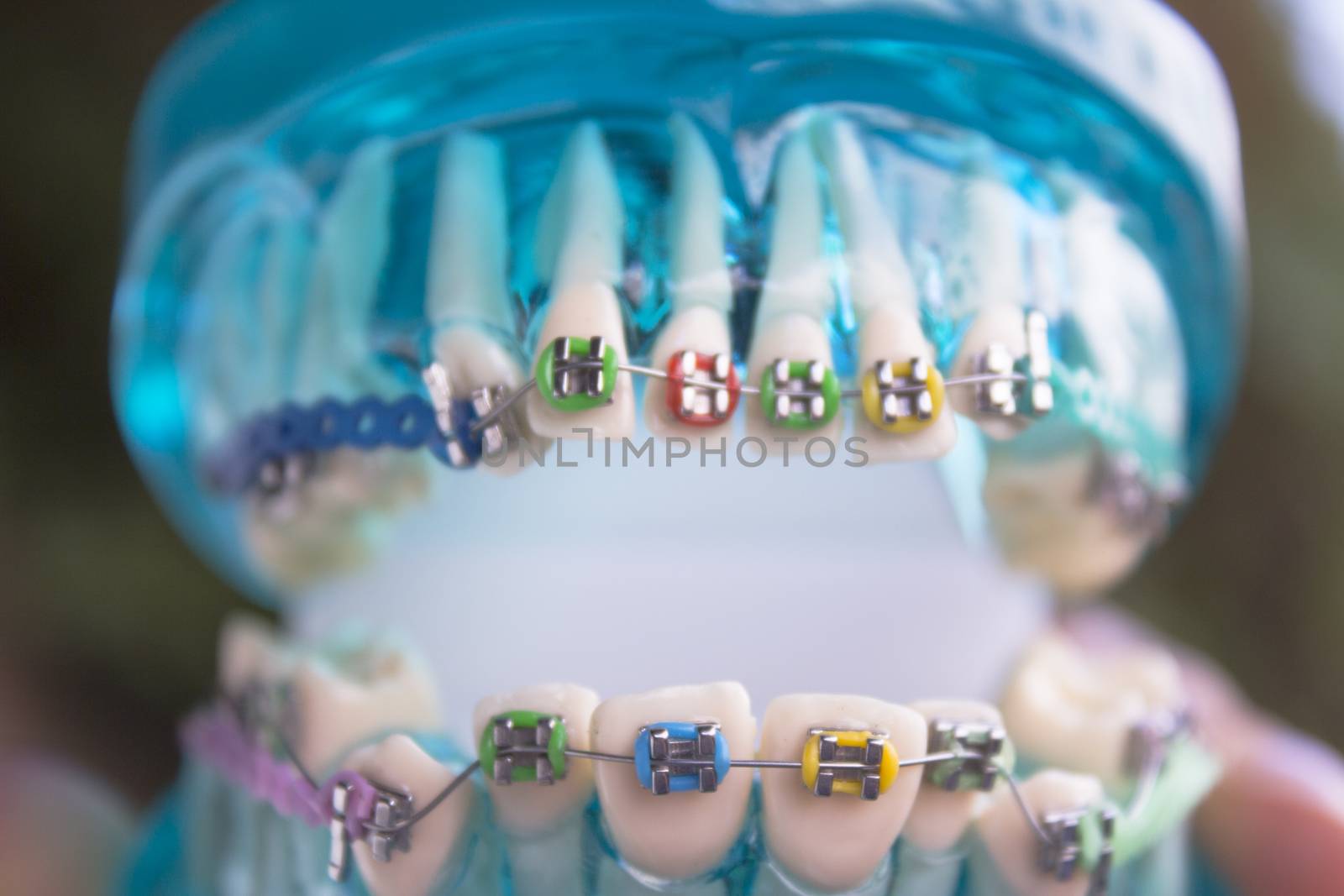 Denture for students with classic dental metal orthodontics. Color aesthetic couplings.