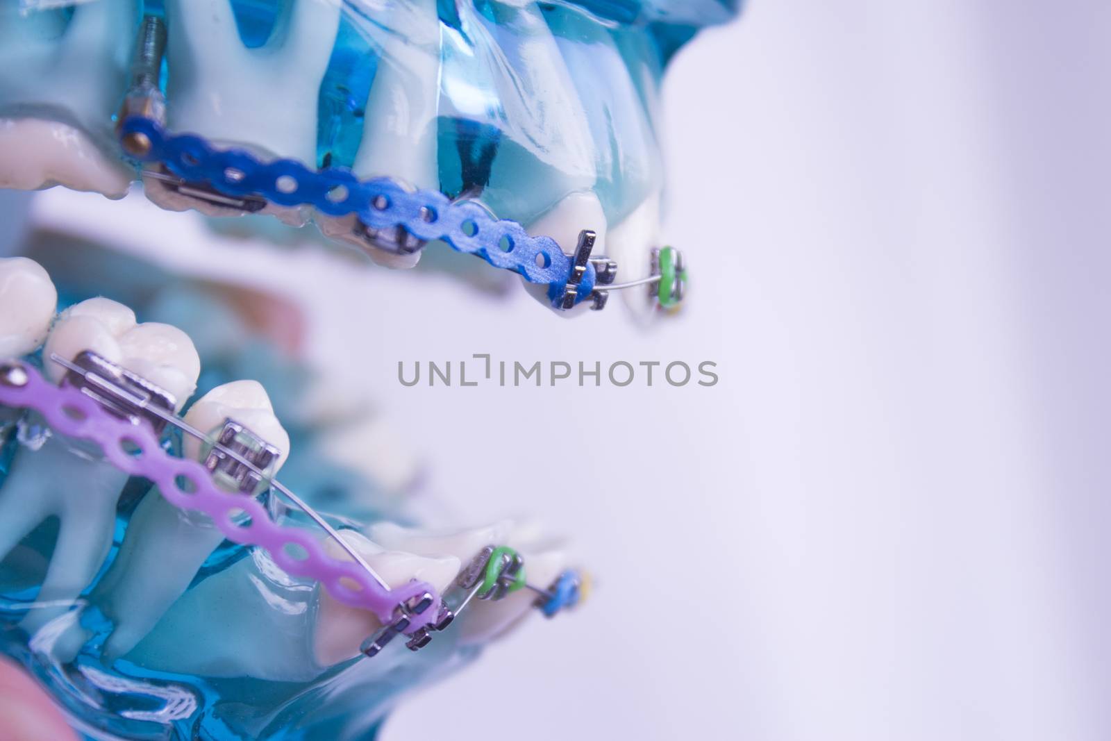 Denture for students with classic dental metal orthodontics. Color aesthetic couplings.