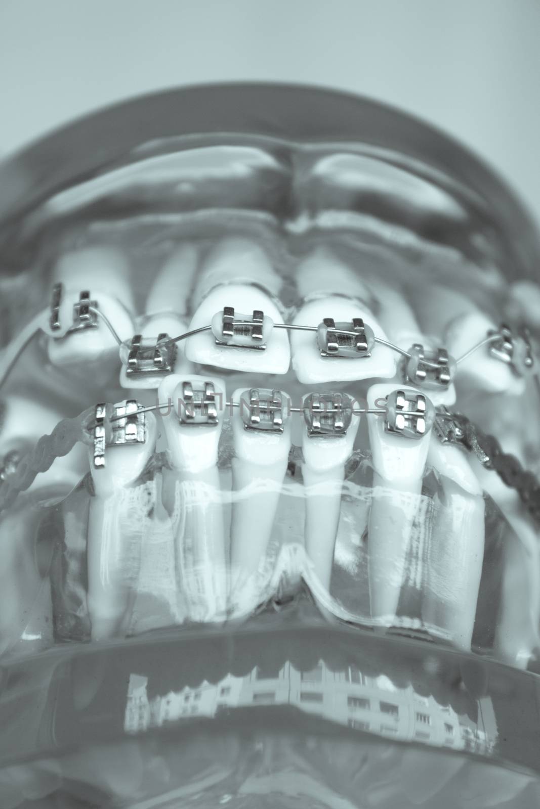 Denture for students with classic dental metal orthodontics. Color aesthetic couplings.