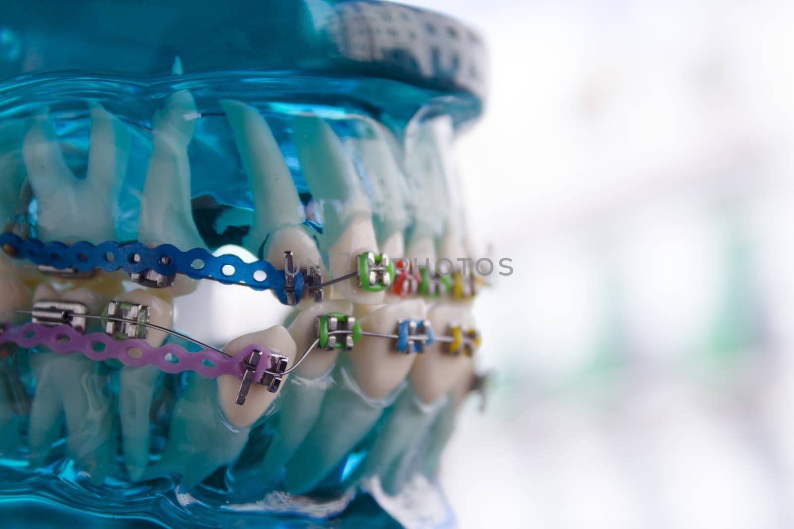 Denture for students with classic dental metal orthodontics. Color aesthetic couplings.