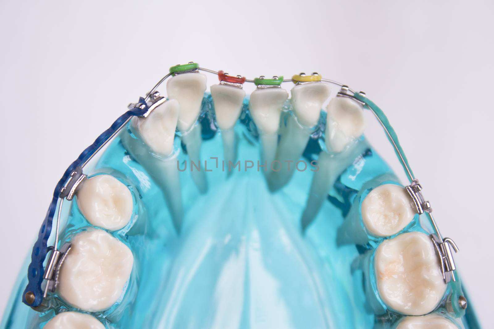 Denture for students with classic dental metal orthodontics. Color aesthetic couplings.