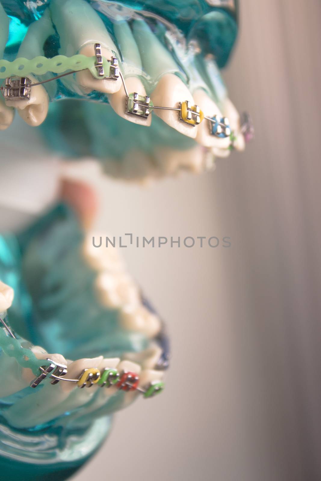 Classic dental metal orthodontics with colored hooks by GemaIbarra