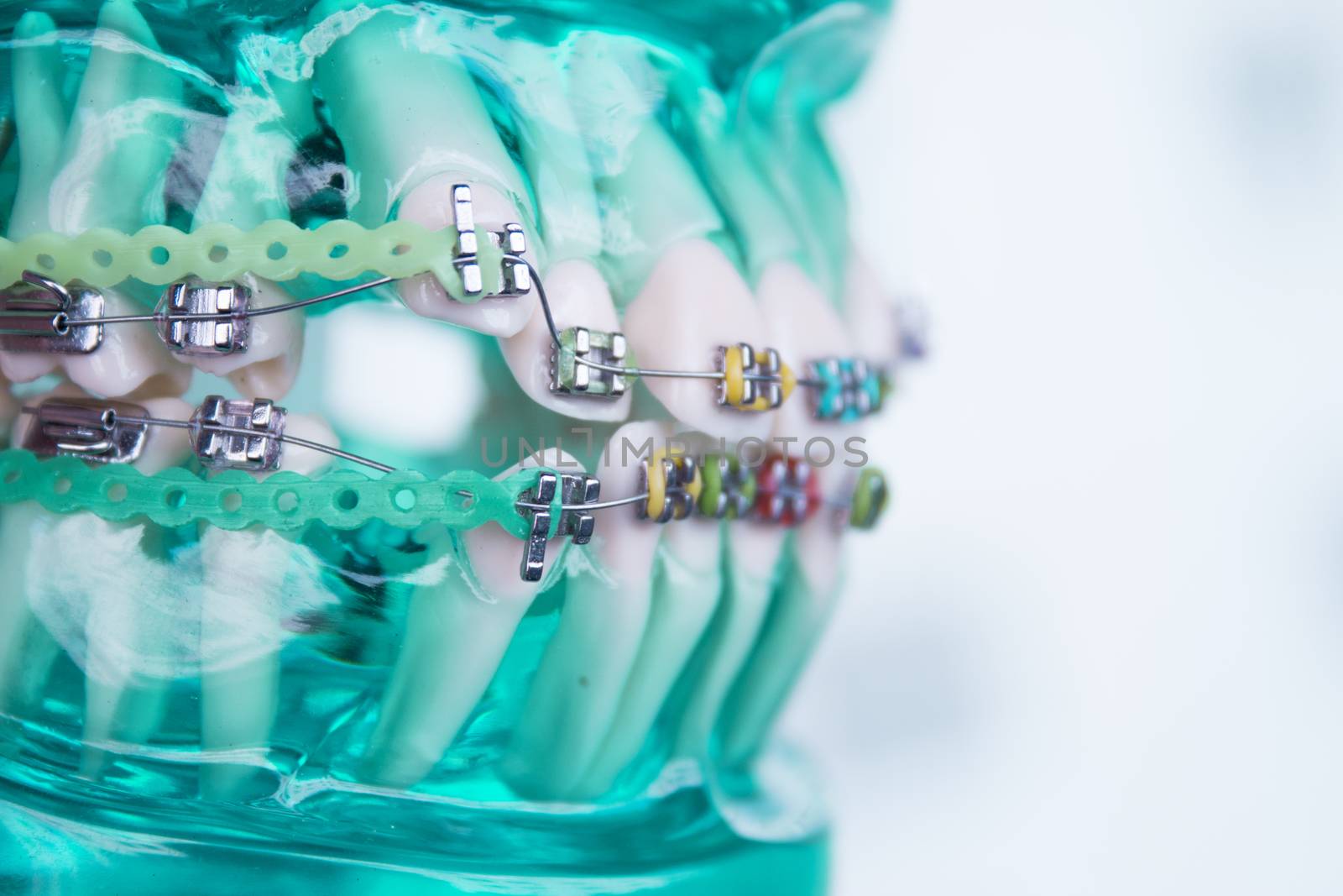 Denture for students with classic dental metal orthodontics. Color aesthetic couplings.