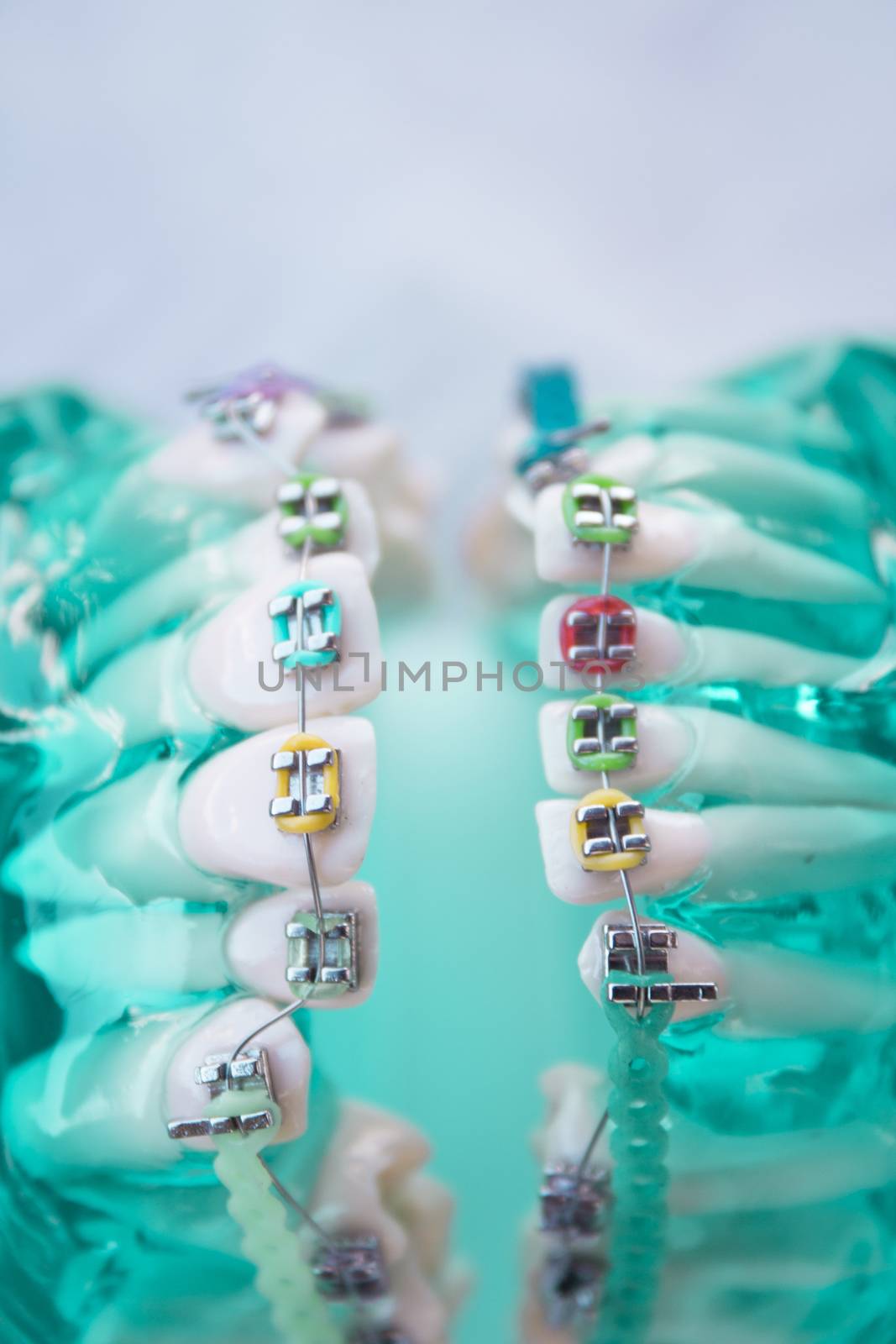 Classic dental metal orthodontics with colored hooks by GemaIbarra