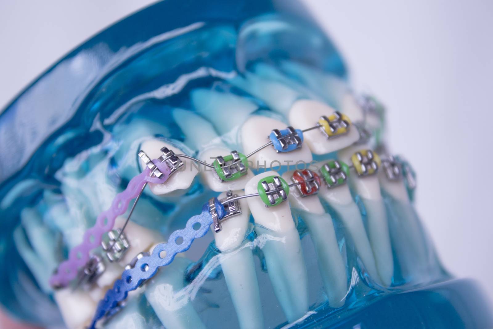 Denture for students with classic dental metal orthodontics. Color aesthetic couplings.