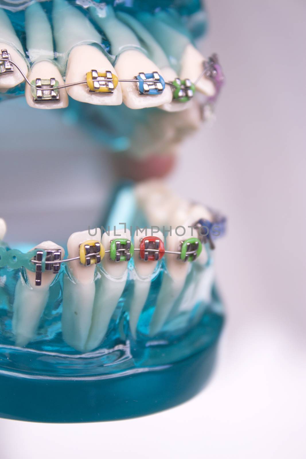 Classic dental metal orthodontics with colored hooks by GemaIbarra