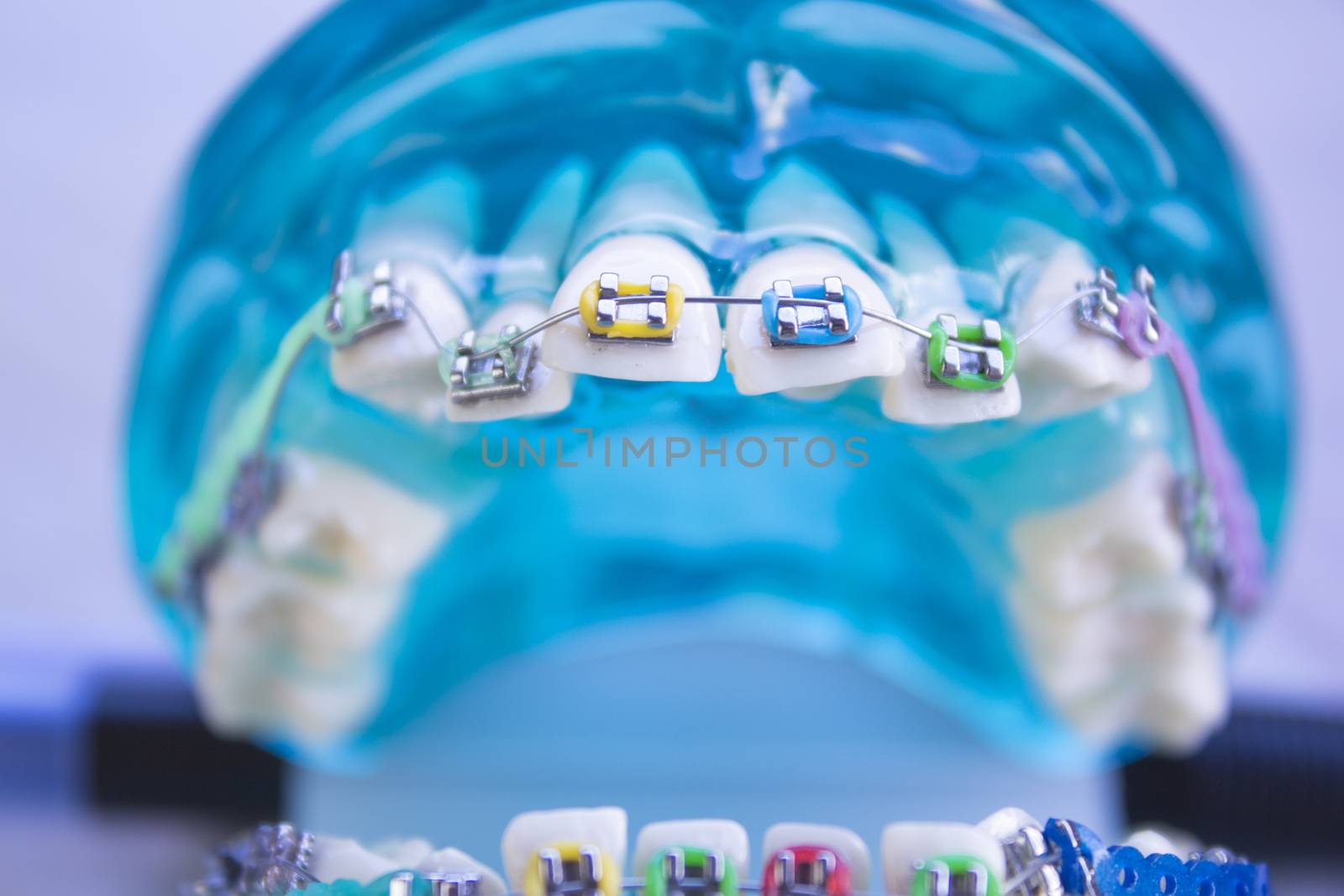 Denture for students with classic dental metal orthodontics. Color aesthetic couplings.