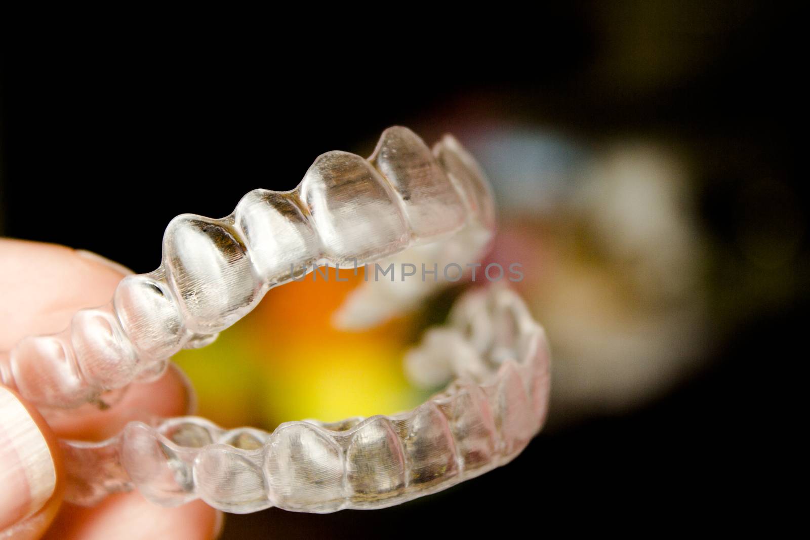 Invisible orthodontics to align the teeth