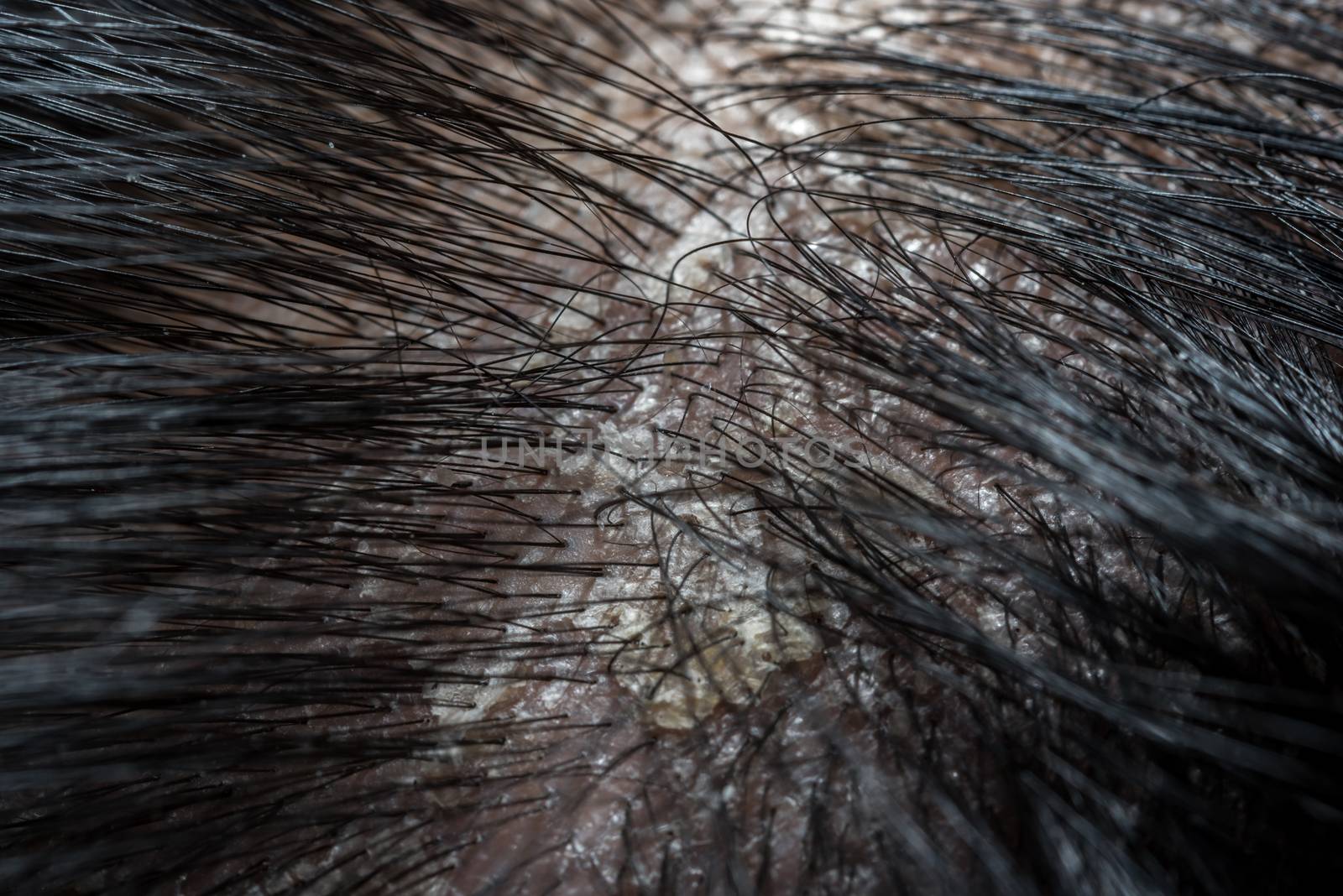 Hair scalp with dandruff and scaly from psoriasis by PongMoji