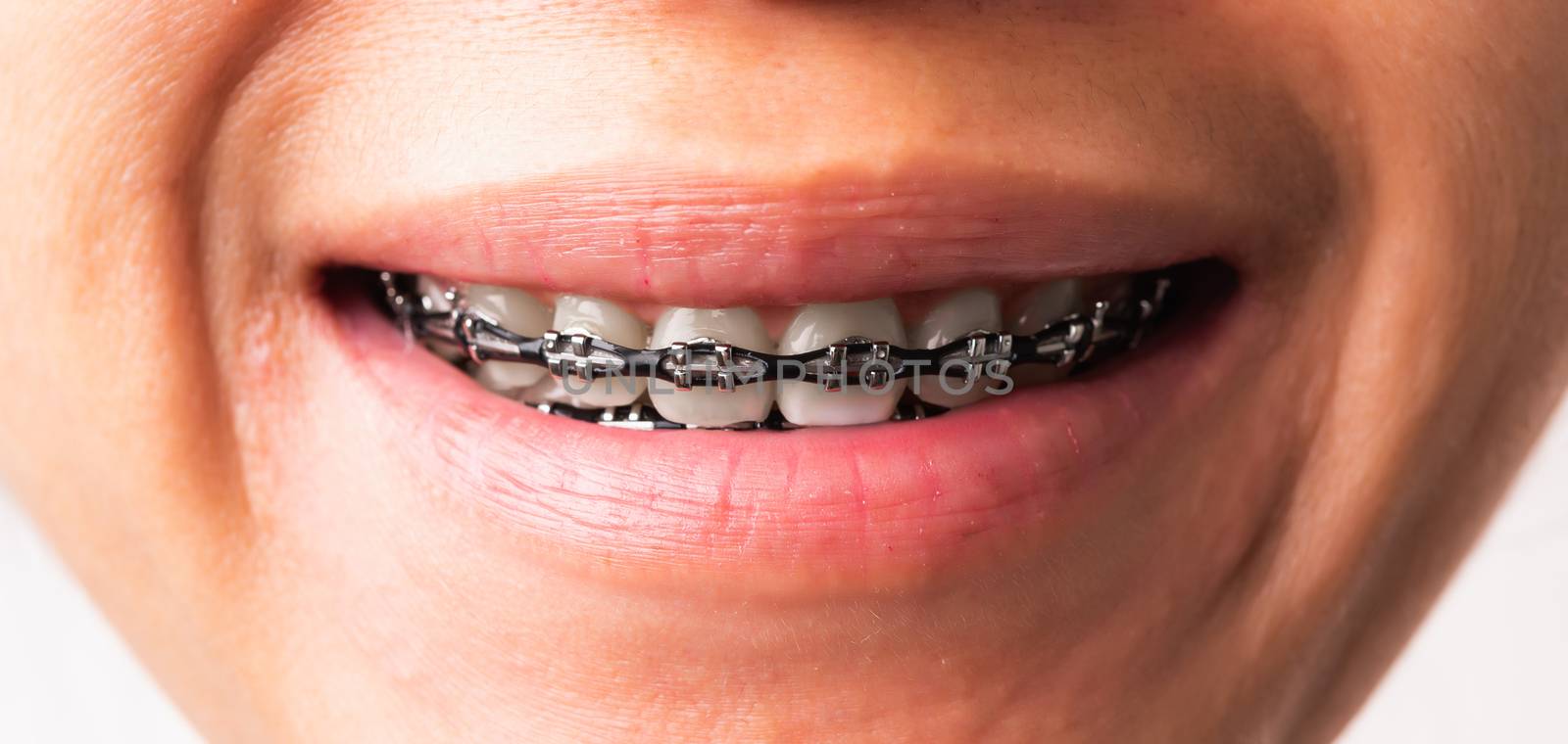 Close up detail macro of young Asian woman smile show mouth with white teeth with black brackets braces, studio shot isolated on white background, Healthcare dental braces concept