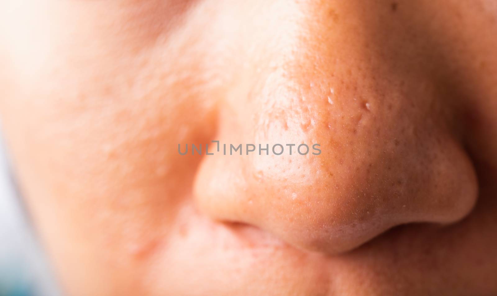 Closeup Asian young woman large pores have freckles cheek oily, acne pimple on nose, studio shot isolated on white background, Healthcare beauty skin face problem concept