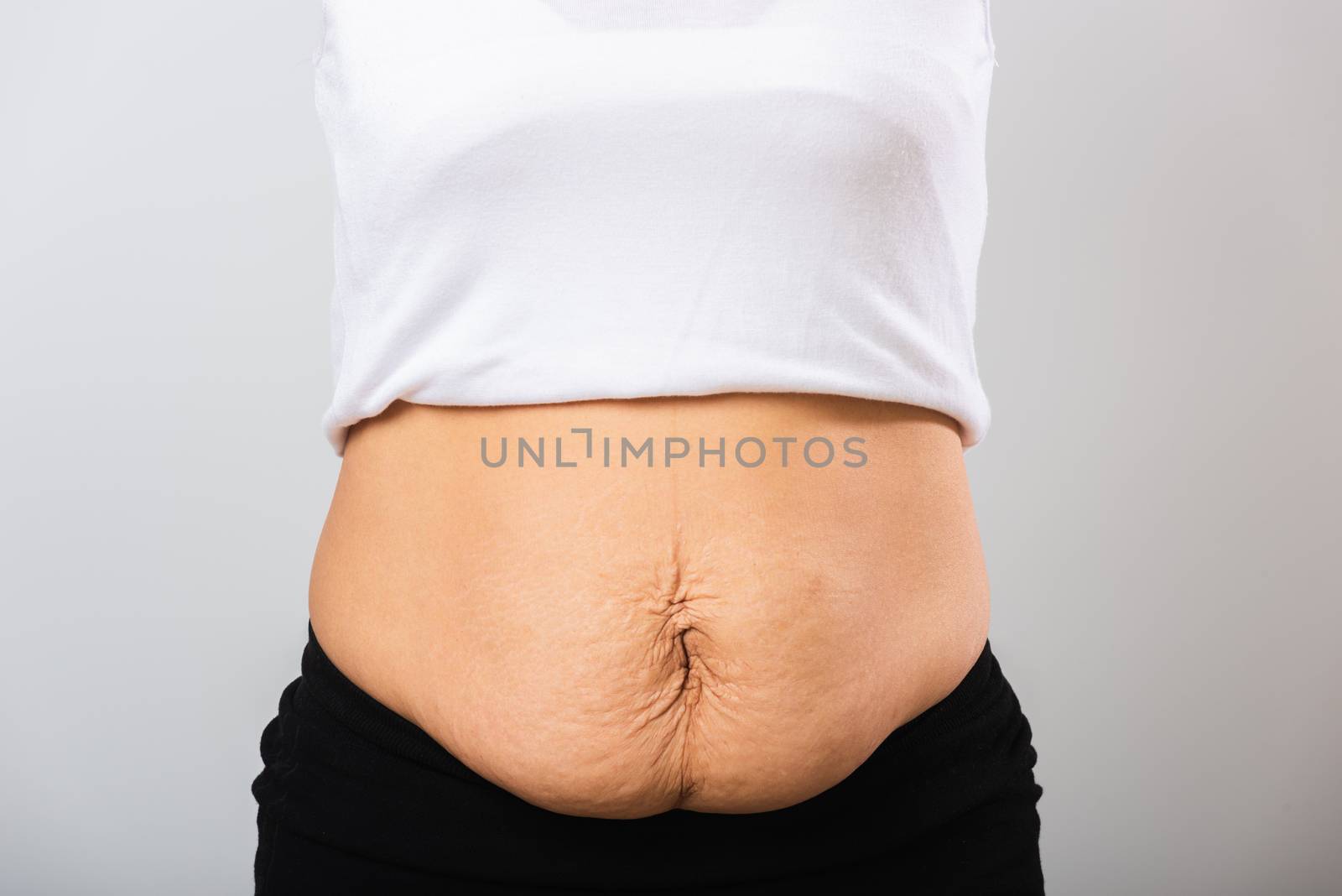 woman showing stretch mark loose lower abdomen skin she fat afte by Sorapop