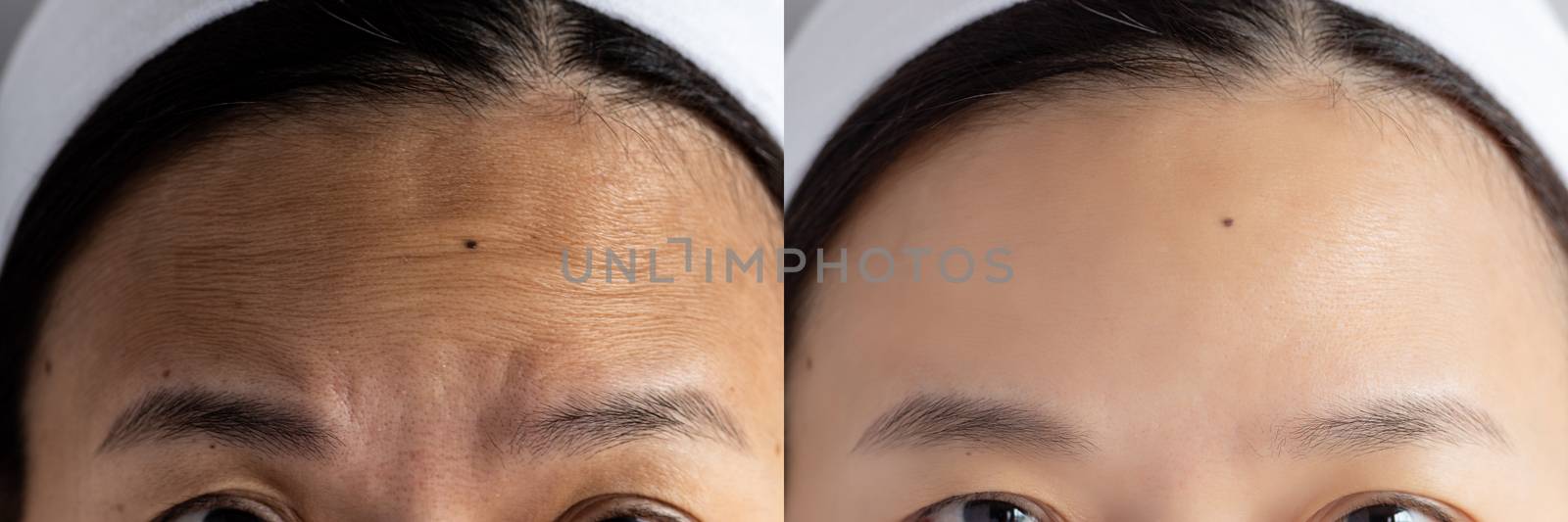 forehead wrinkles problem. pictures compared effect Before and After treatment for forehead wrinkles skin problem in woman to solve skin problem for better skin result by asiandelight