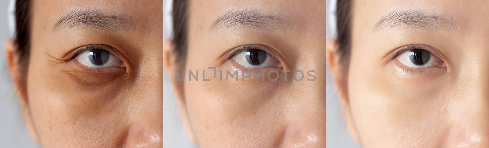 three pictures compared effect Before and After treatment. under eyes with problems of dark circles ,puffiness and wrinkles periorbital before and after treatment to solve skin problem for better skin