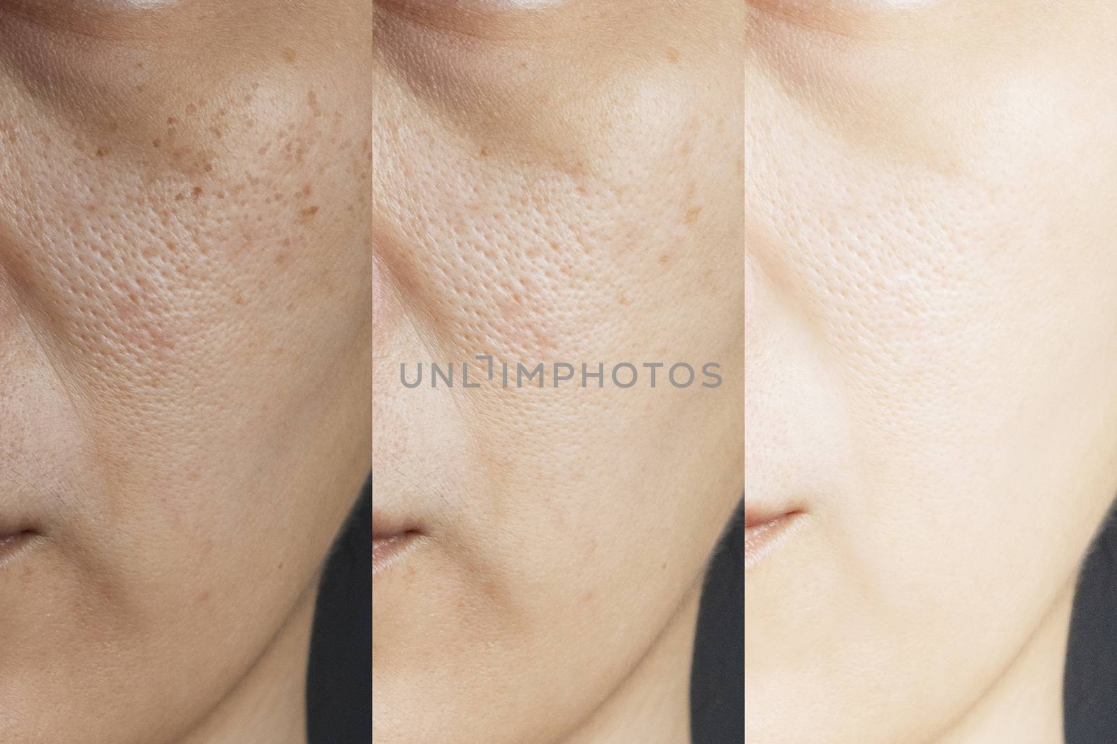 three pictures compared effect Before and After treatment. skin with problems of freckles , pore , dull skin and wrinkles before and after treatment to solve skin problem for better skin result