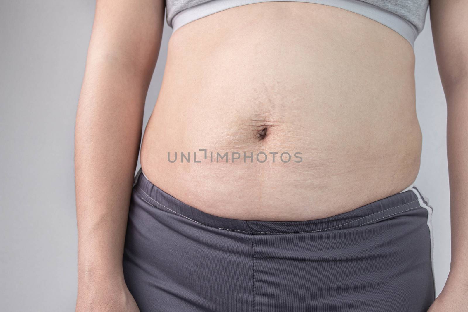 Close-up front view of Woman belly skin with stretch marks and loose skin after giving birth. Health care for skin and body shape concept.