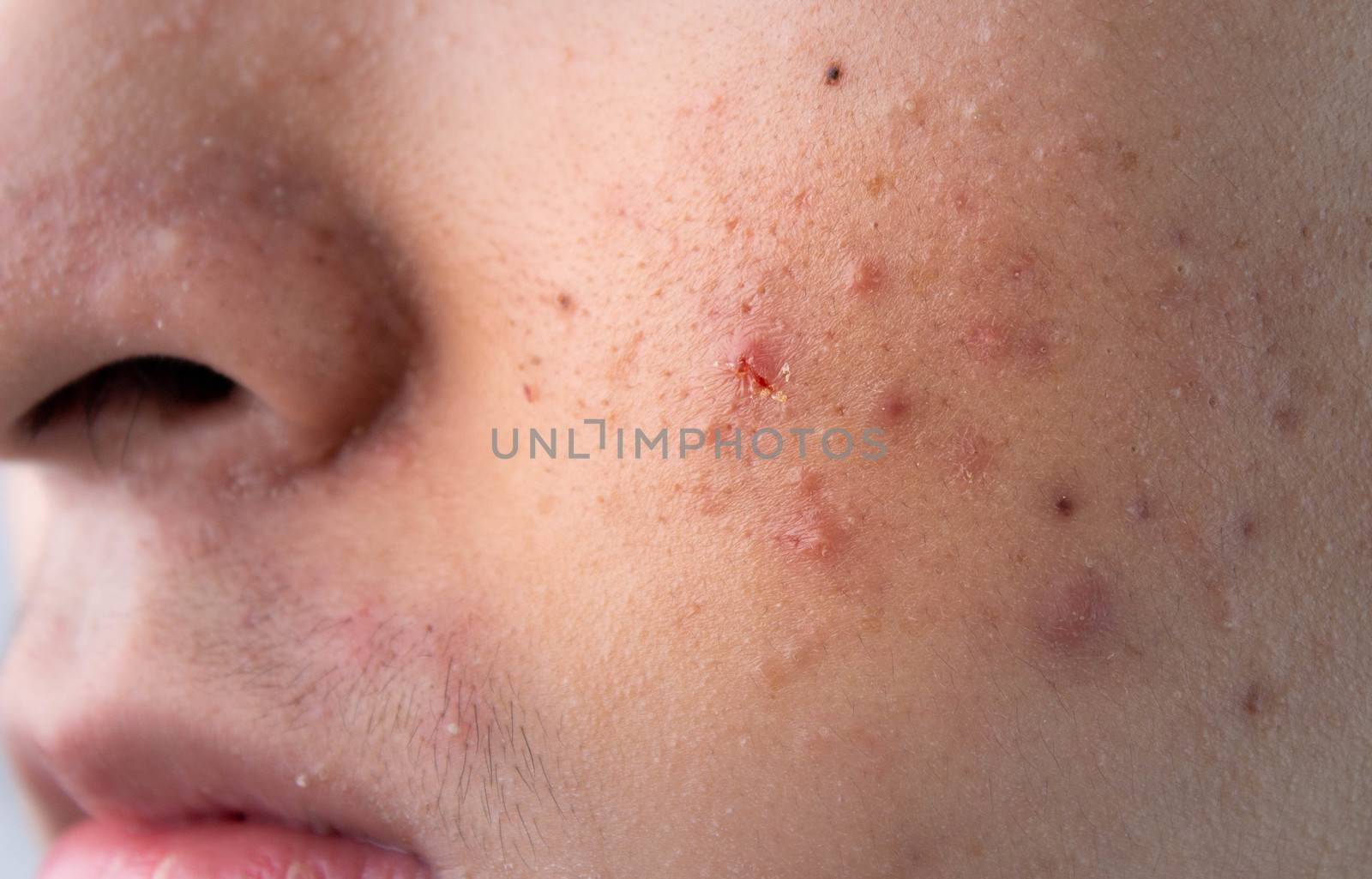 Close up face of Asian teenage guy with acne and problem skin. Skin care concept. by TEERASAK