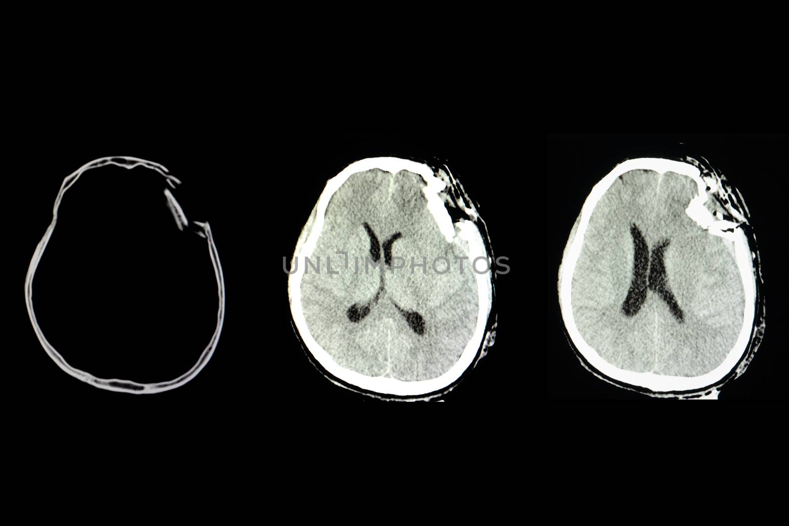 CT scan of a patient with traumatic brain injury showing depression skull fracture in the frontotemporol region with brain edema