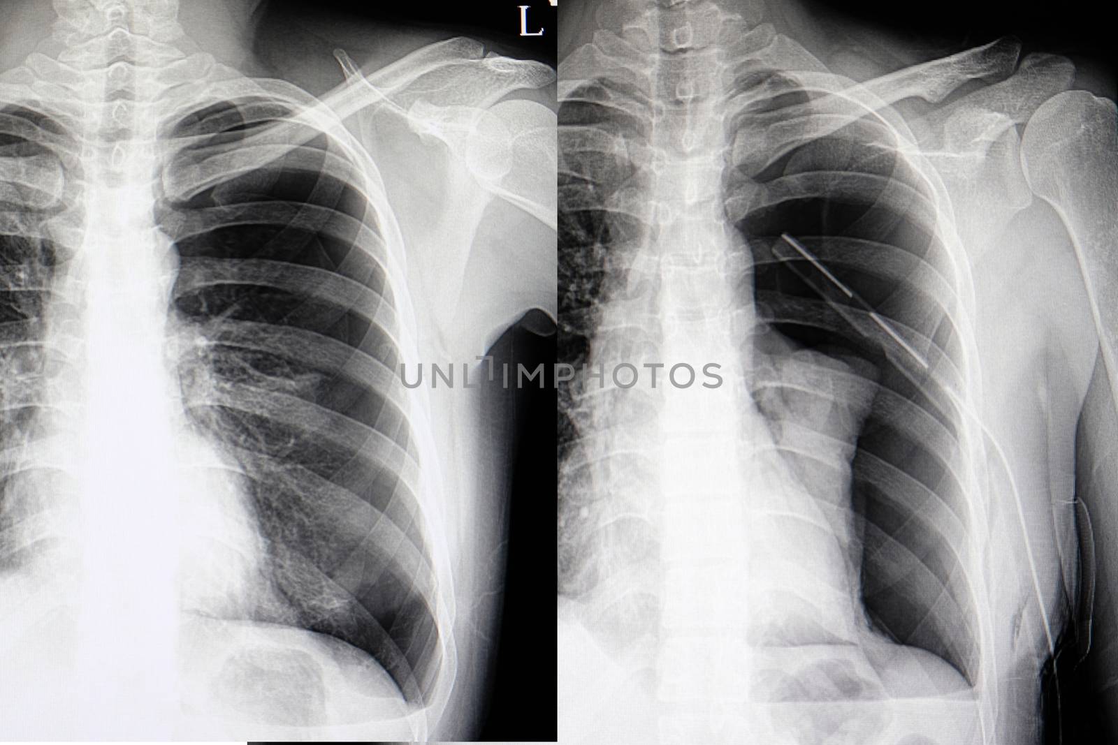 Chest xray films of a patient having spontaneous pneumothorax from ruptured lung bleb, showing a chest drain tube in his left lung.
