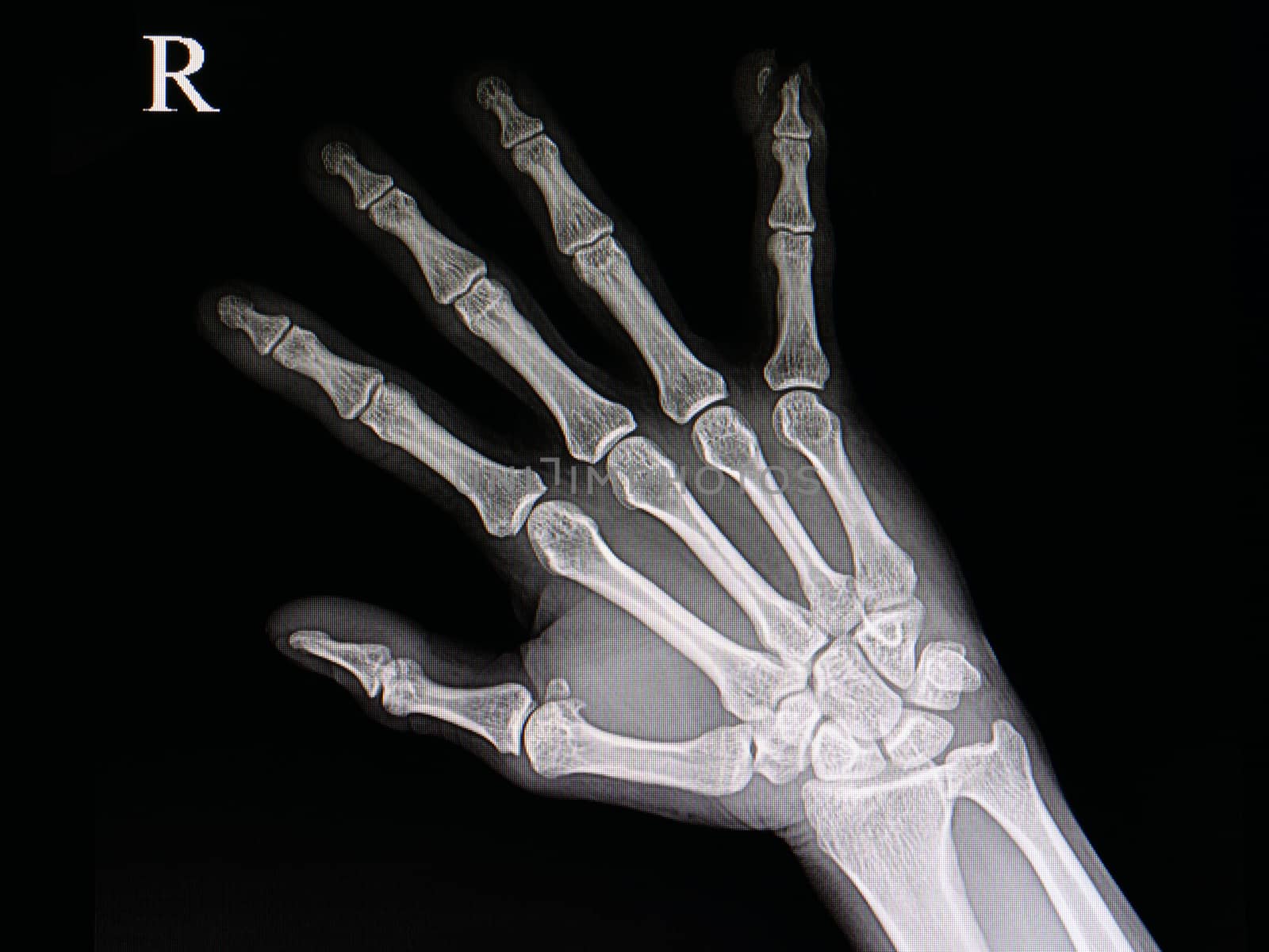 xray of a hand of a patient with accidental traumatic amputation of little finger tip
