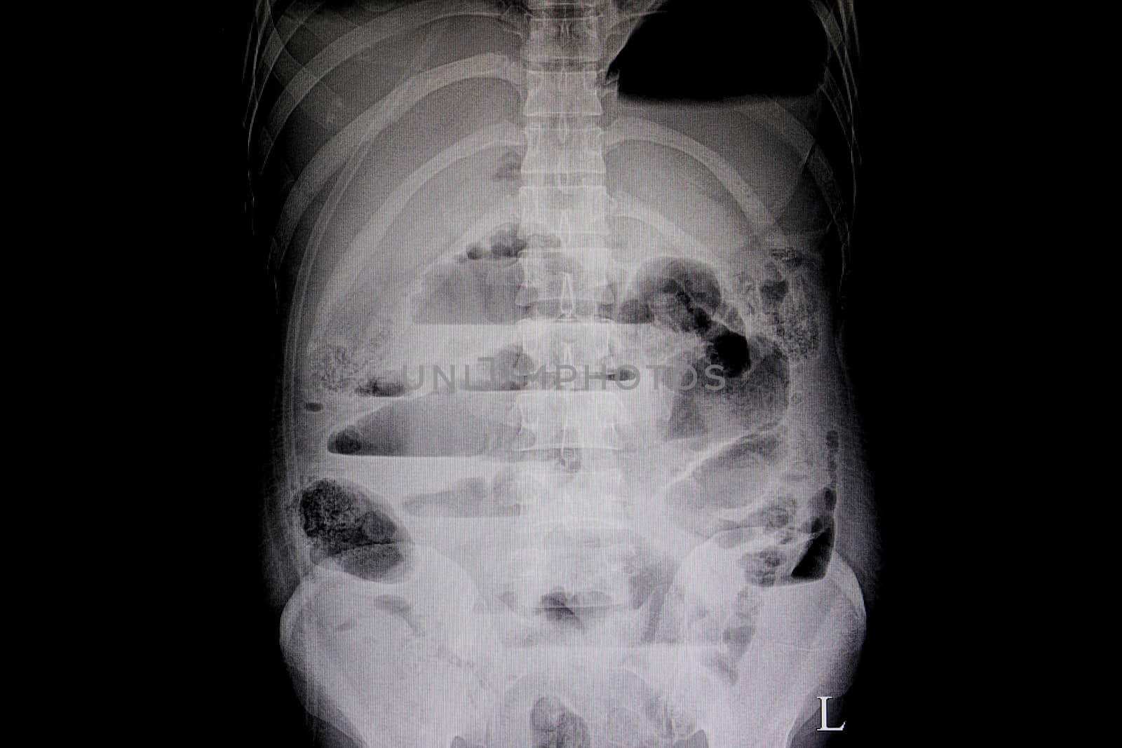 A plain abdominal upright film of a patient showing mechanical bowel obstration with internal air fluid level in loop of bowels. Step ladder pattern film.