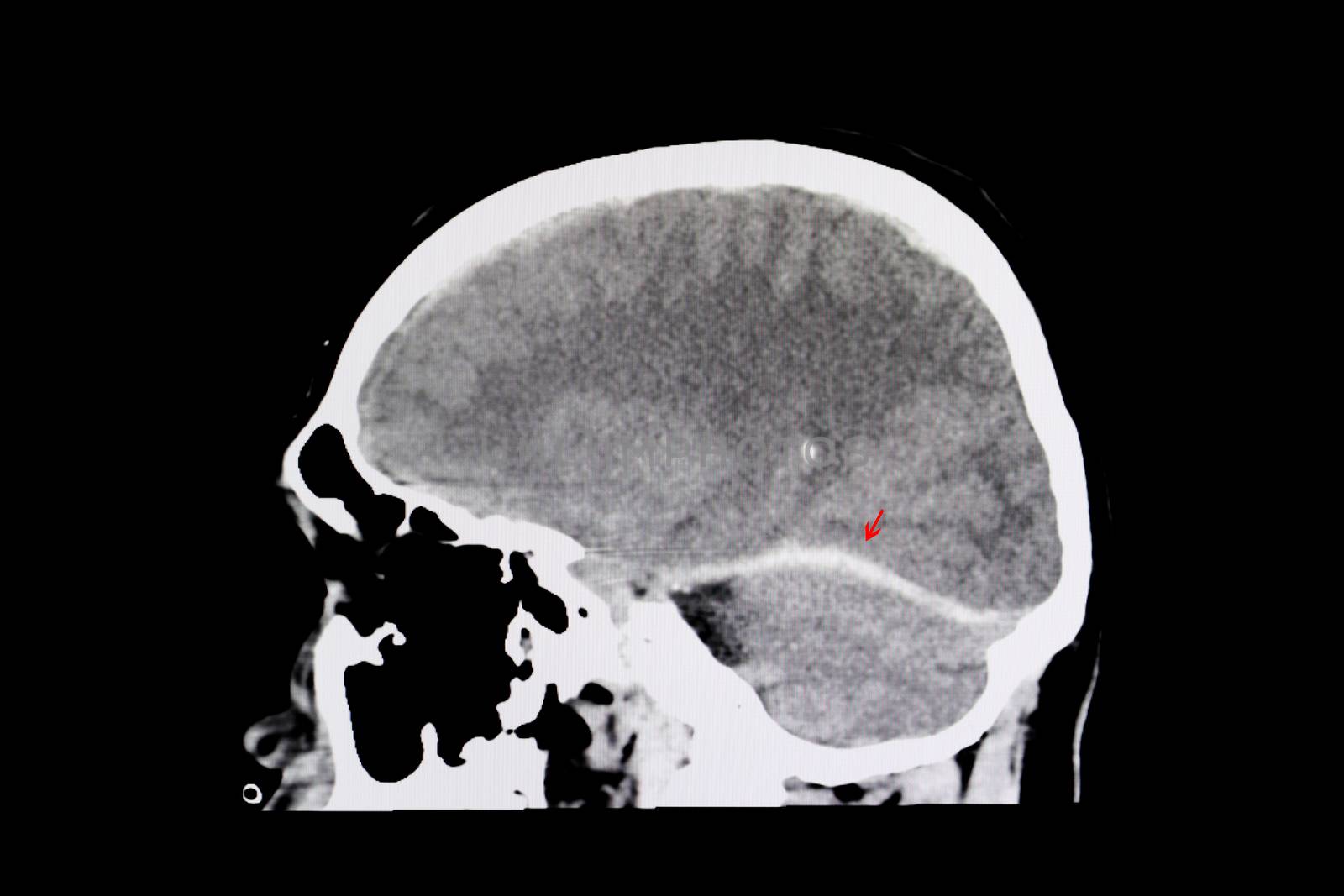 intracerebral hemorrhage by Nawoot