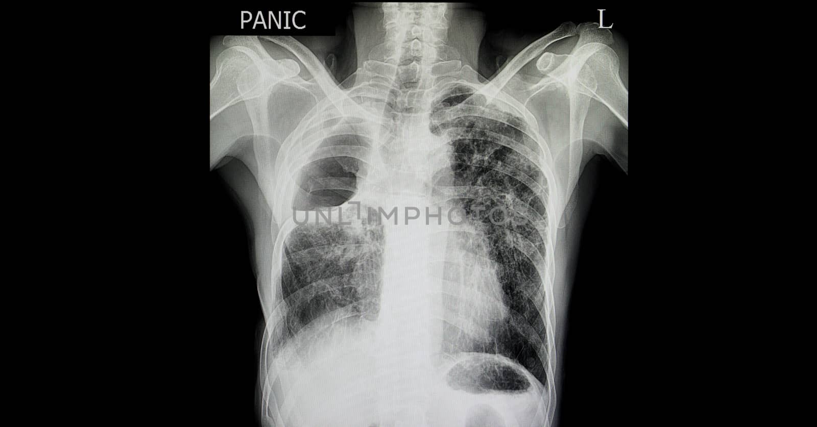 A chest film of a patient with a history of right upper lung resection showing a large cavity. Tuberculous or malignant lymphangitic spreading of the remaining lung tissues with left lower pulmmonary nodule is noted.