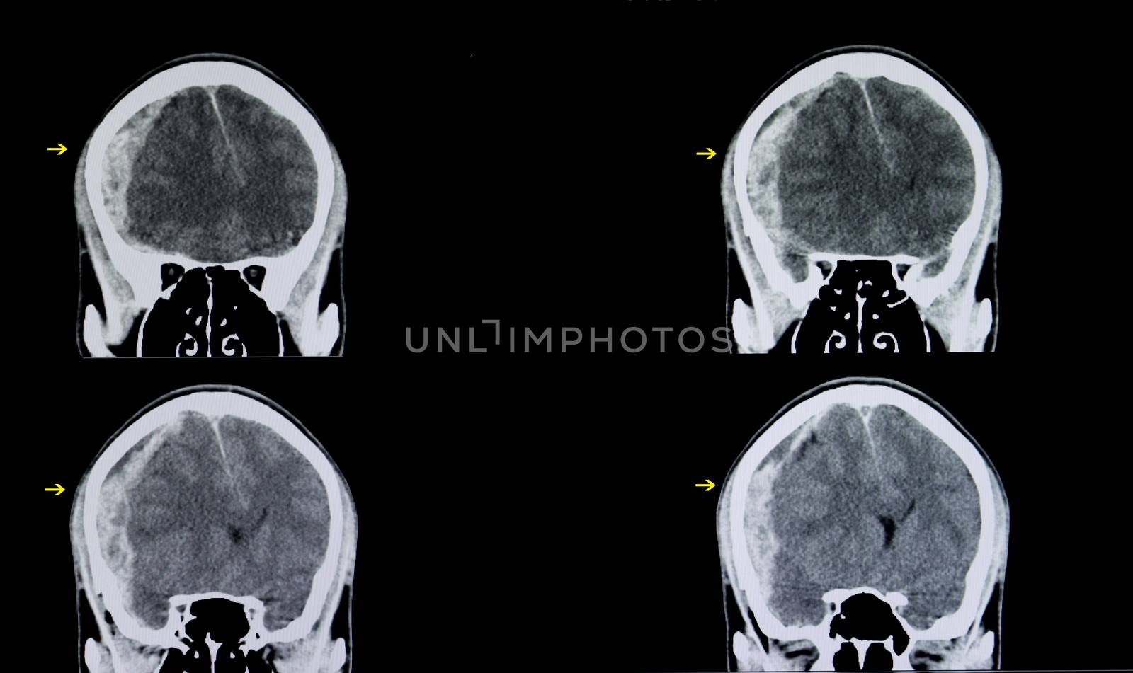 CT scan of a brain of a patient with traumatic head injury showing large subarachnoid hemorrhage in his right cerebral hemisphere with edema causing herniation of the tissue to the left side.
