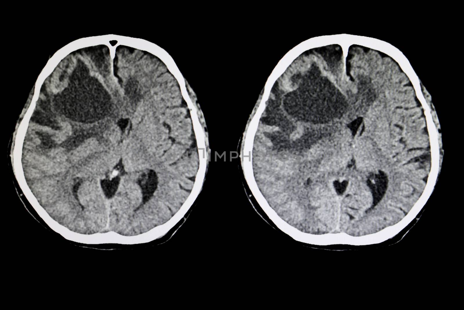 CT scan of a brain of a patient with a large metastatic tumor with cerebral edema.