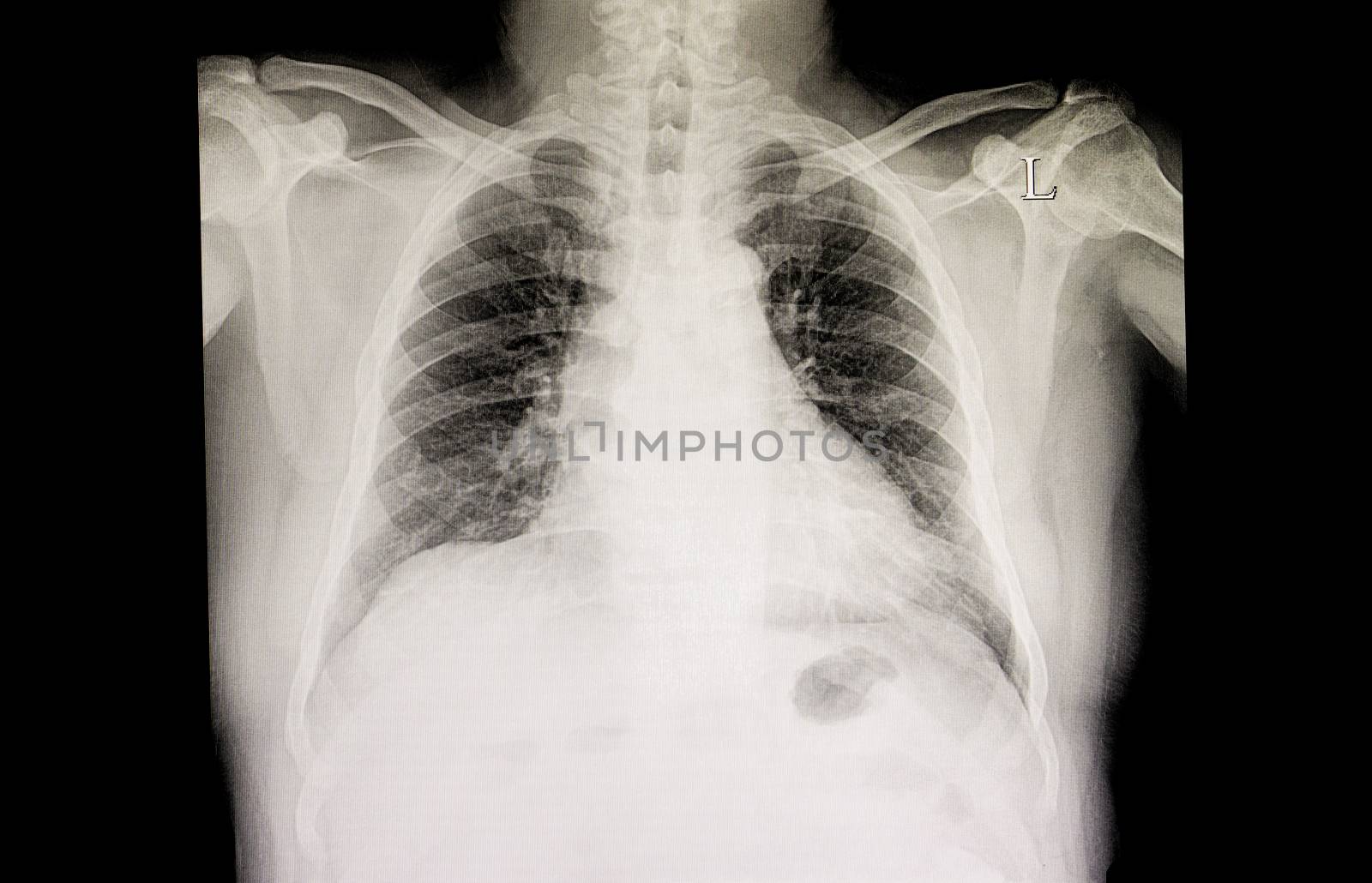 A chest xray film of a patient with cardiomegaly and early lung congestion