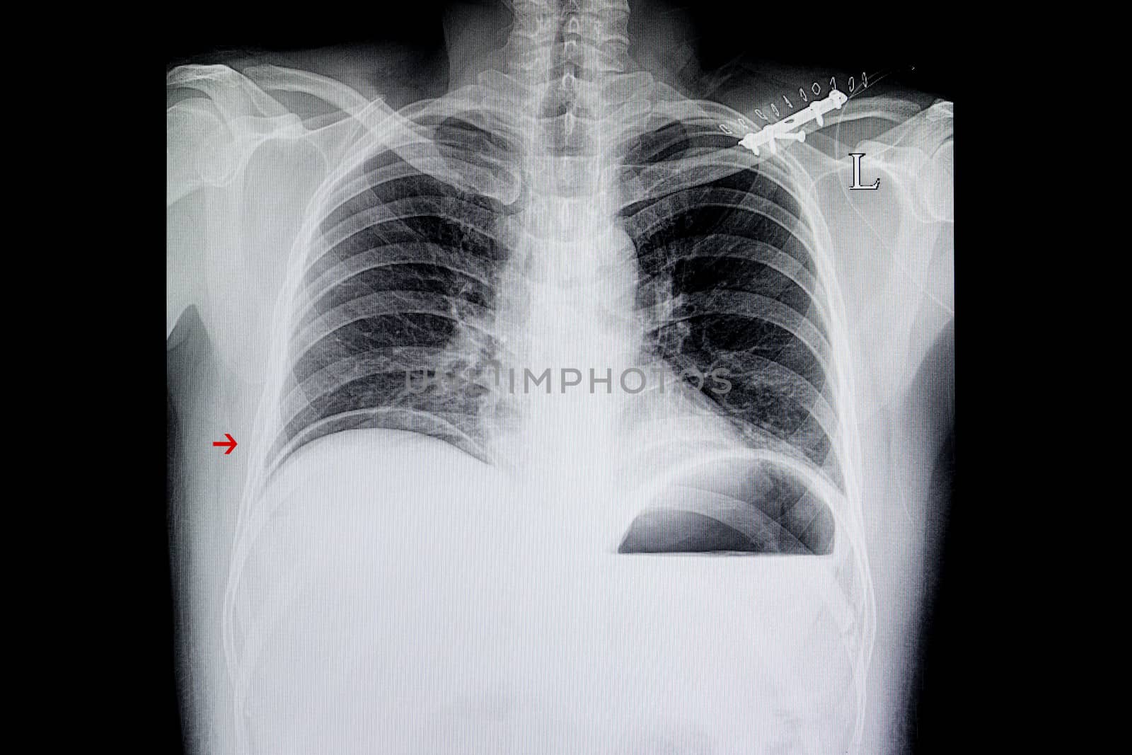Chest xray film of a posttraumatic patient showing free air under dome of right diaphragm from hollow abdominal organs rupture.