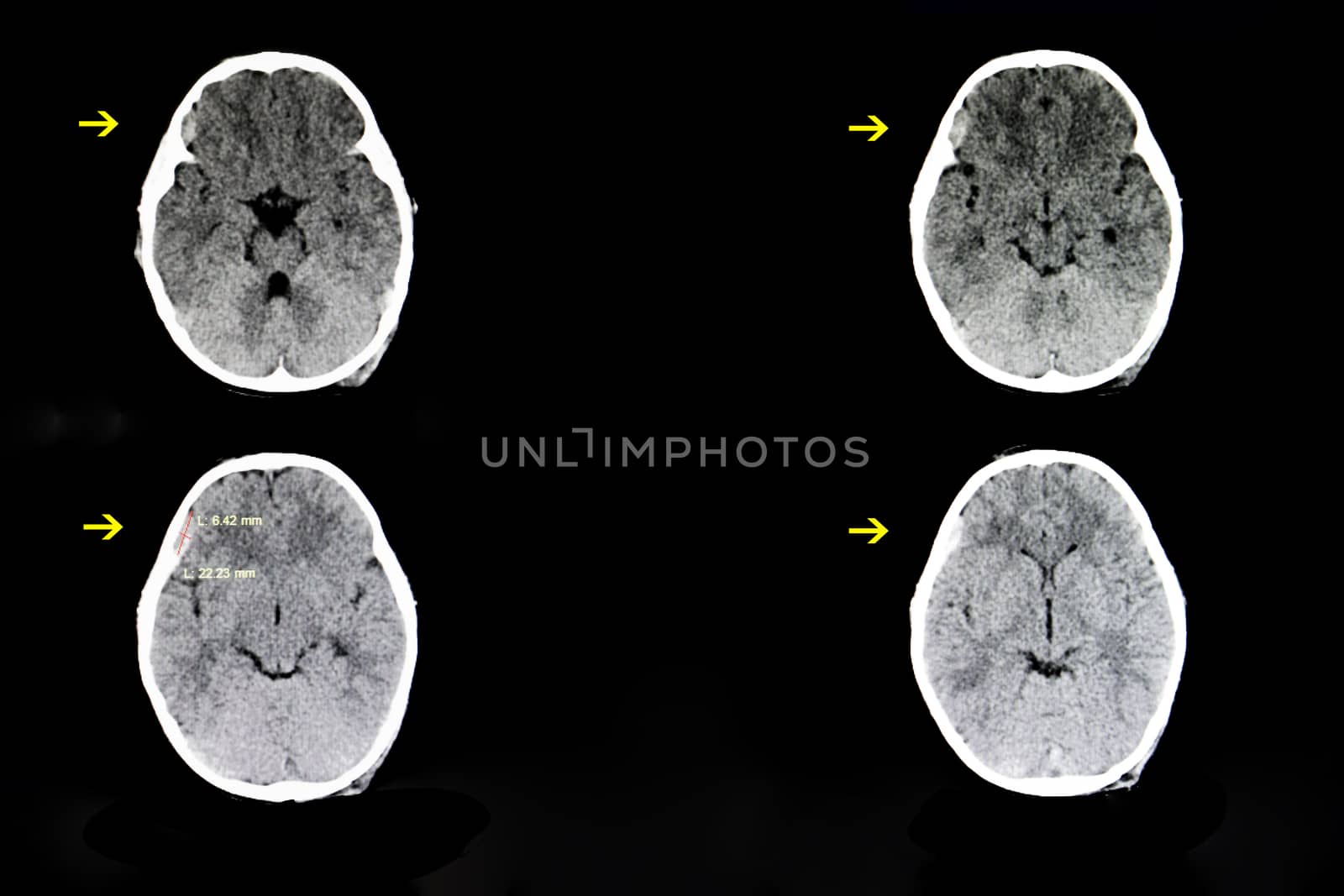 CT scan of a brain of a 4 year old child with a history of crush injury (hit by a falling TV) showing a small subdural hematoma in his right frontotemporal cerebral area.