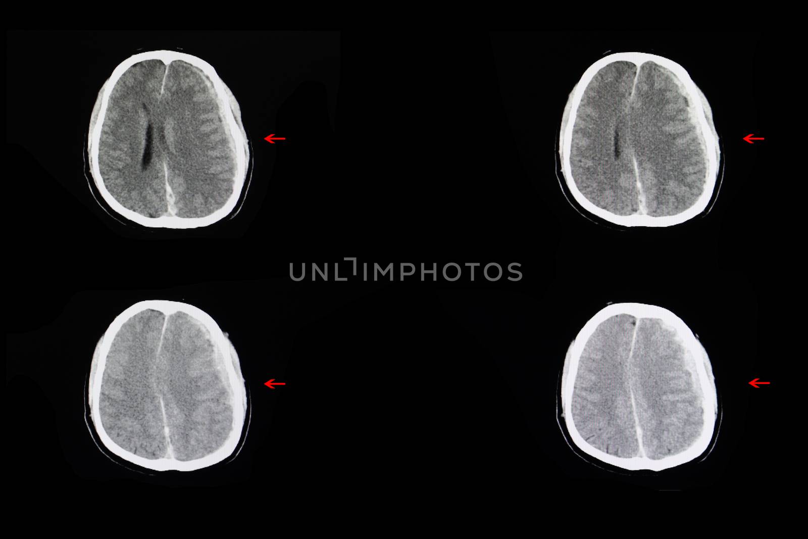 CT scan of a brain of a patient with subdural hemorrhage and cerebral edema from trauamatic brain injury.