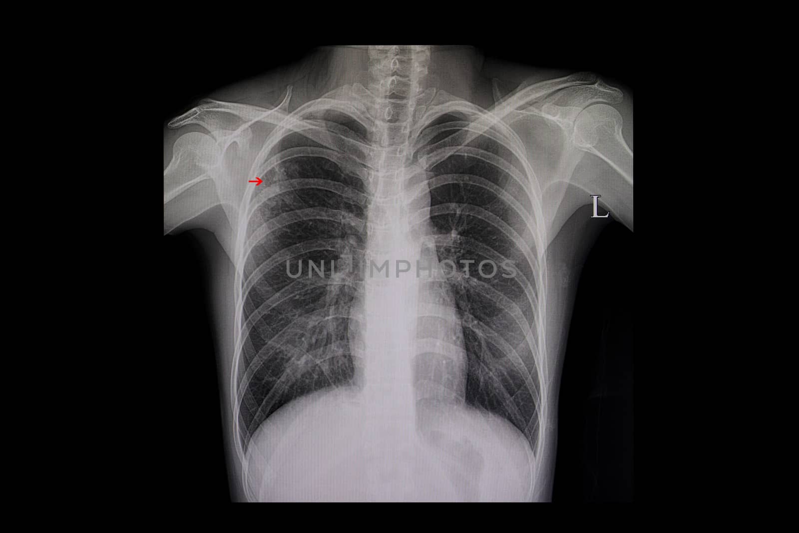 Xray film of a patient with active pulmonary tuberculosis in the right upper lung (red arrow).