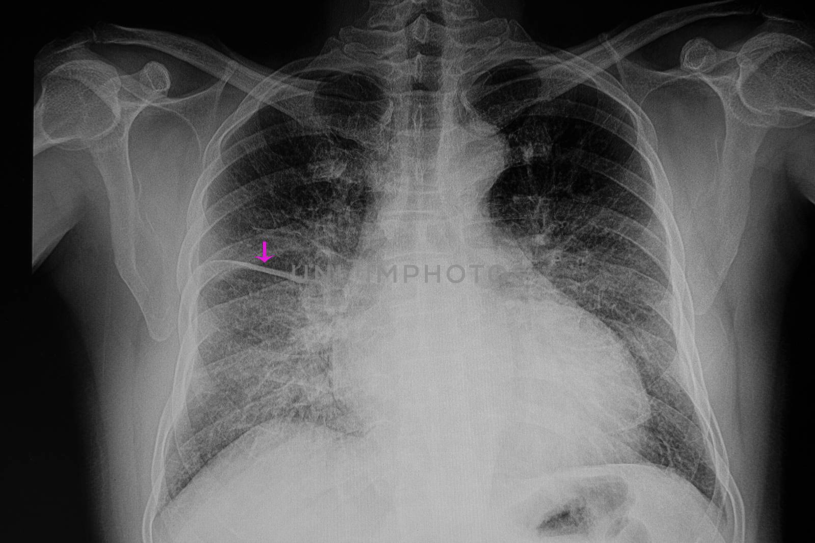 a chest xray film of a patient with cardiomegaly with congestive heart failure and pulmonary edema with fliuid in right lung fissure (arrow)