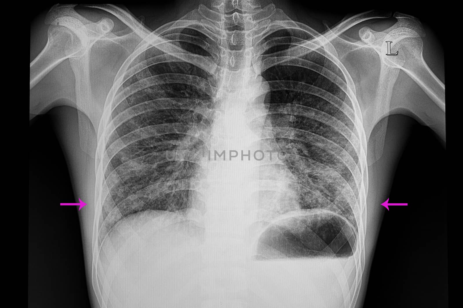 chest xray film of a patient with bilateral lower lungs pneumonia.