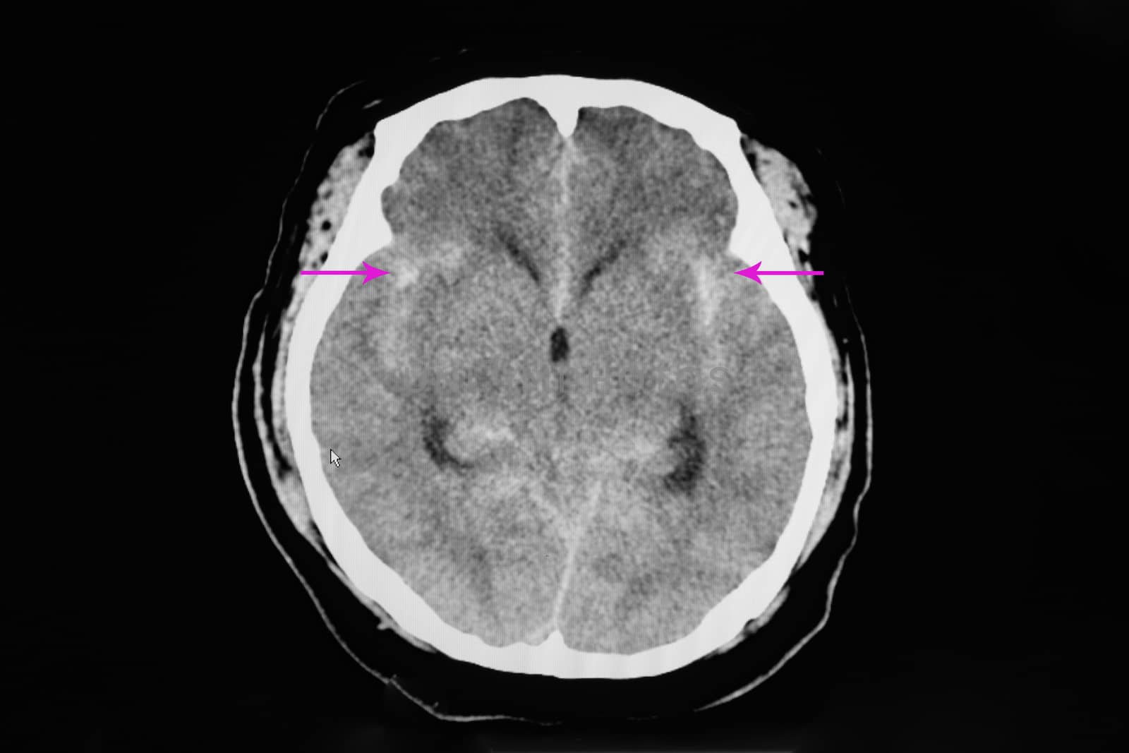 CT brain scan of a patient with tramatic brain injury showing intracerebral hemorrhage patches