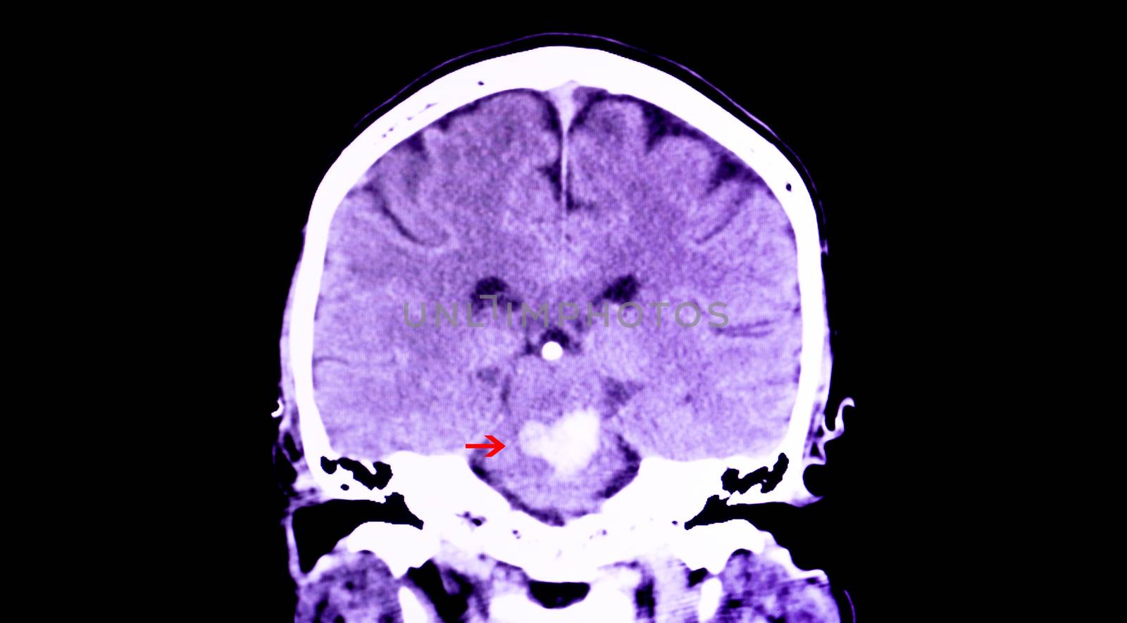 A CT scan of the brain of a patient with intracranial hemorrhage. The lesion is in the pons and extends to the cerebellum.