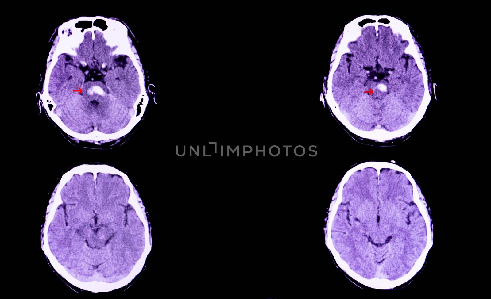 A CT scan of the brain of a patient with intracranial hemorrhage. The lesion is in the pons and extends to the cerebellum.