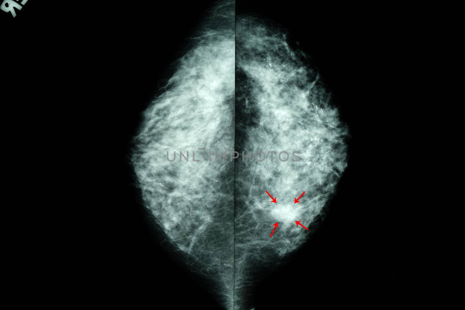 an x-ray image of female breasts or mammogram shing a large nodule with cal calcium deposits in the breast tissue