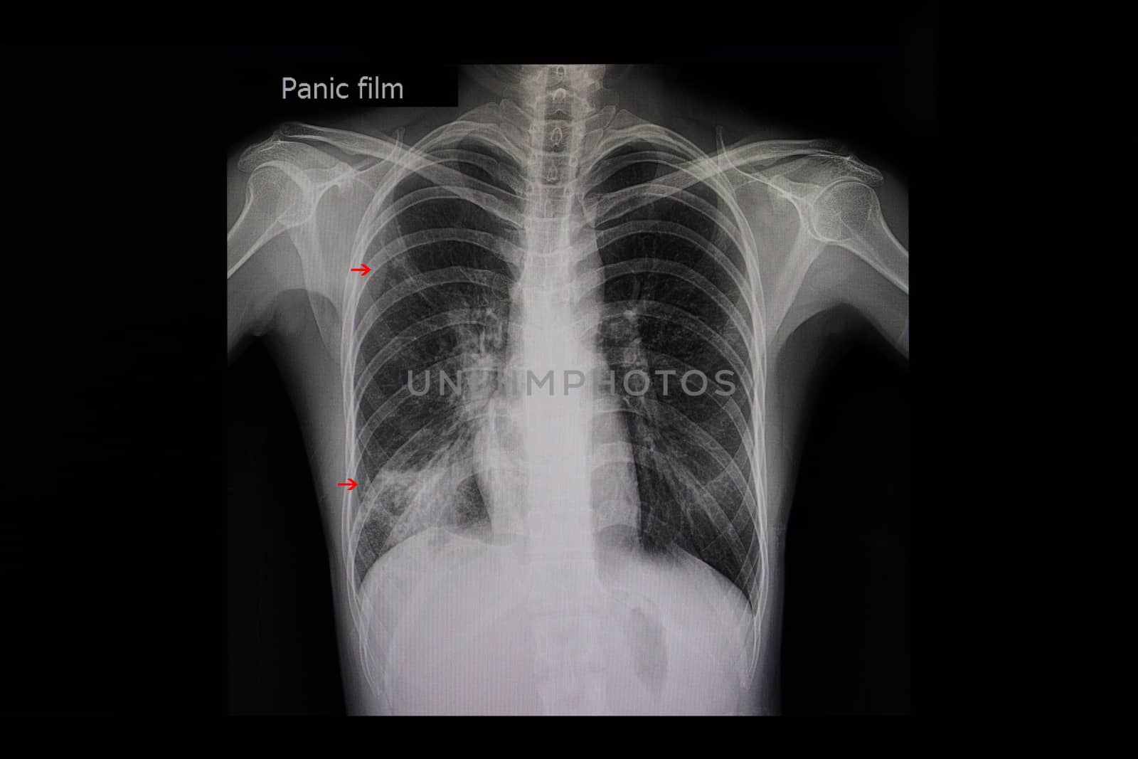 Xray film of a patient with active pulmonary tuberculosis in the right lung (red arrows).