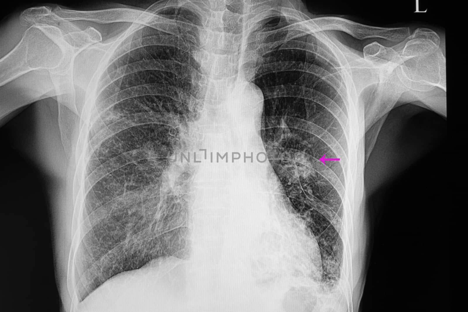 A chest xray film of a patient with right middle and lower lobes pneumonia, left lower lobe pneumonia, and left middle lung nodule.