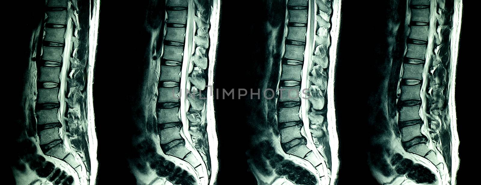 MRI scan of lumbar spines of a patient with chronic back pain showing degenerative change of the lumbar and sacral spines with disc dessication and disc space narrowing and central bulging of L3-4 disc