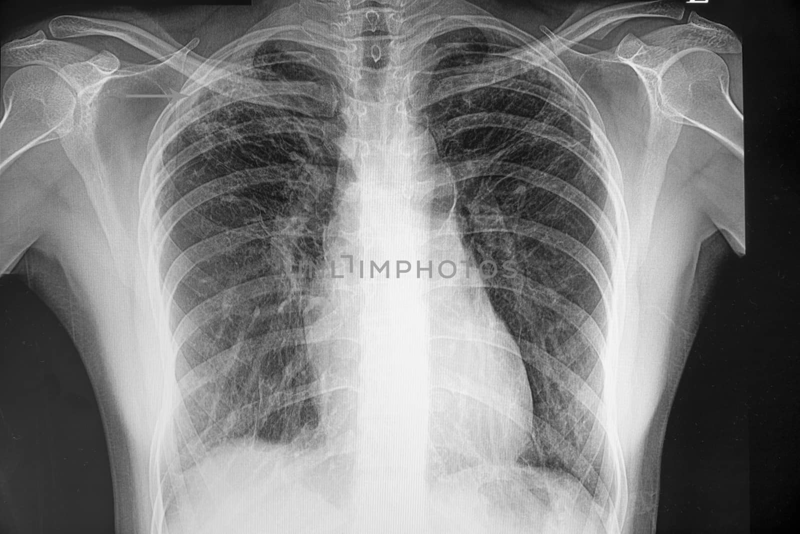 a chest xray film of a patient with pulmonary tuberculosis