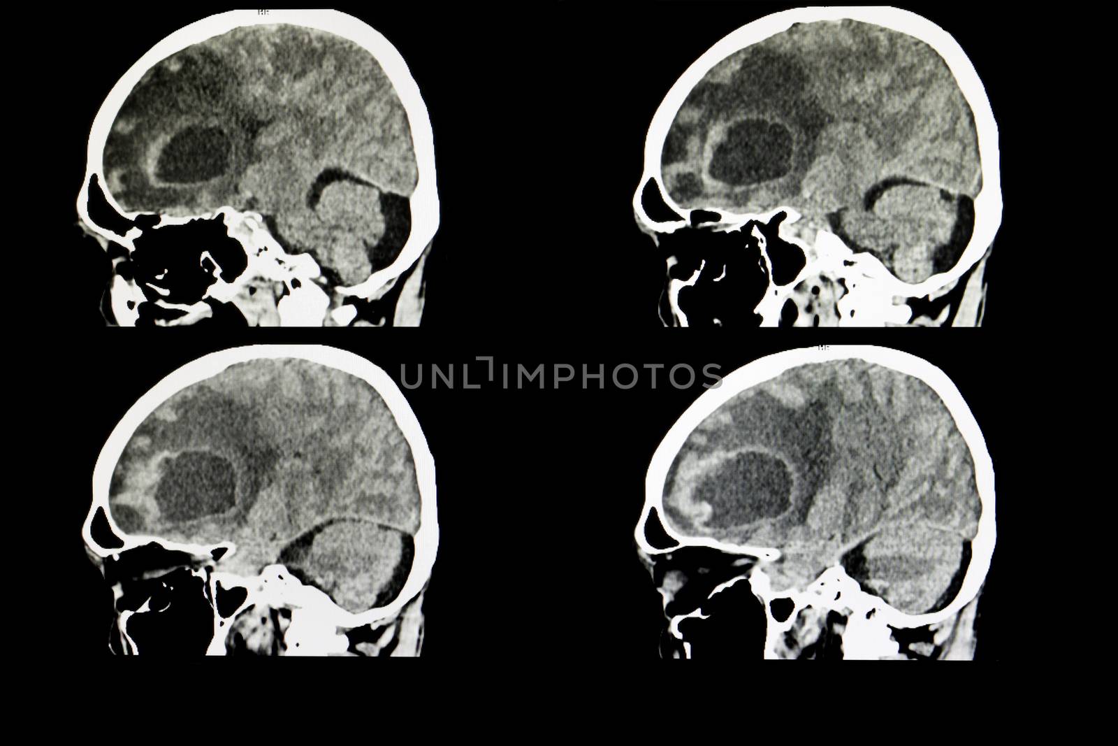 CT scan of a brain of a patient with a large metastatic tumor