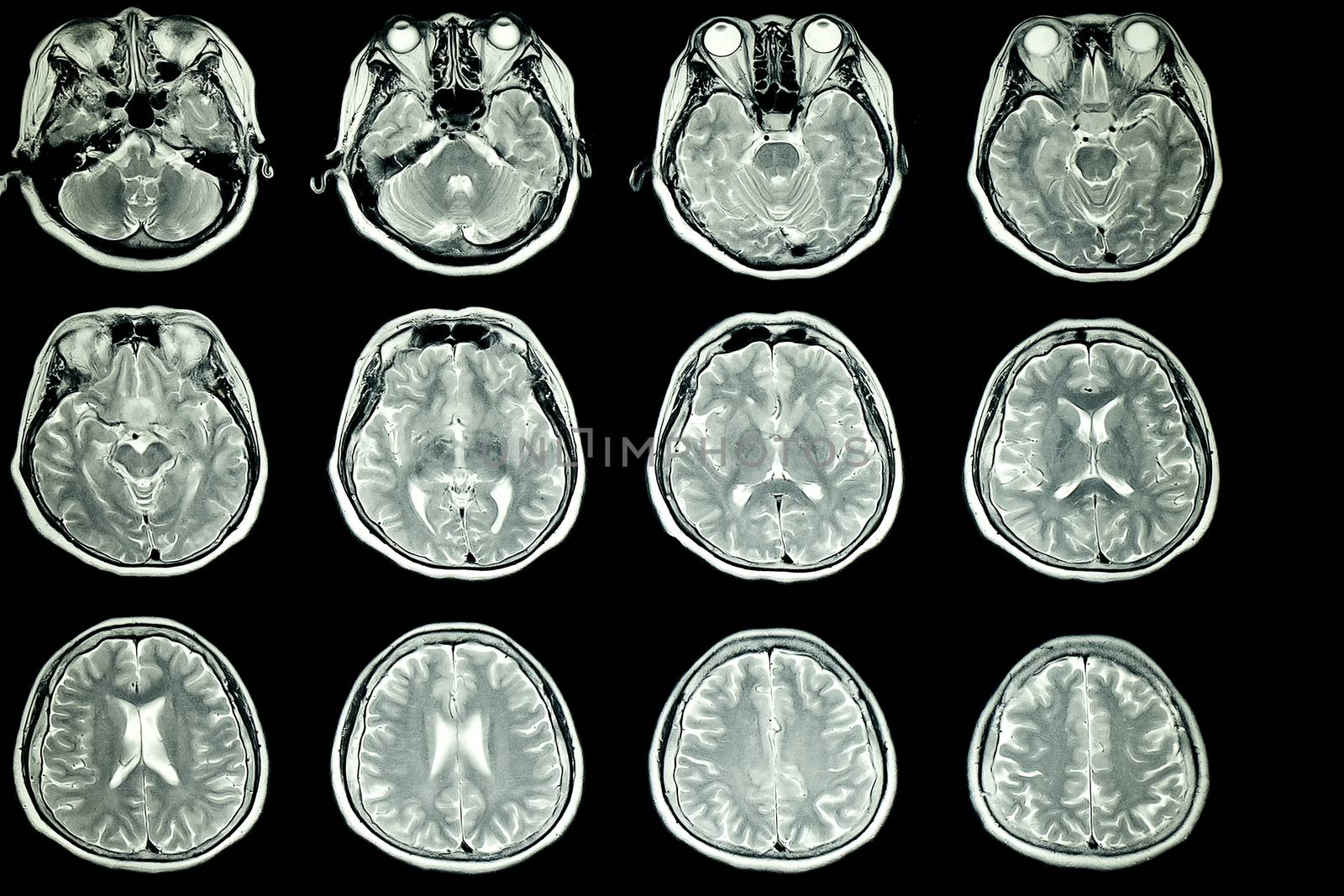 MRI scan of patient brain with normal signal intensity of the brain parenchyma