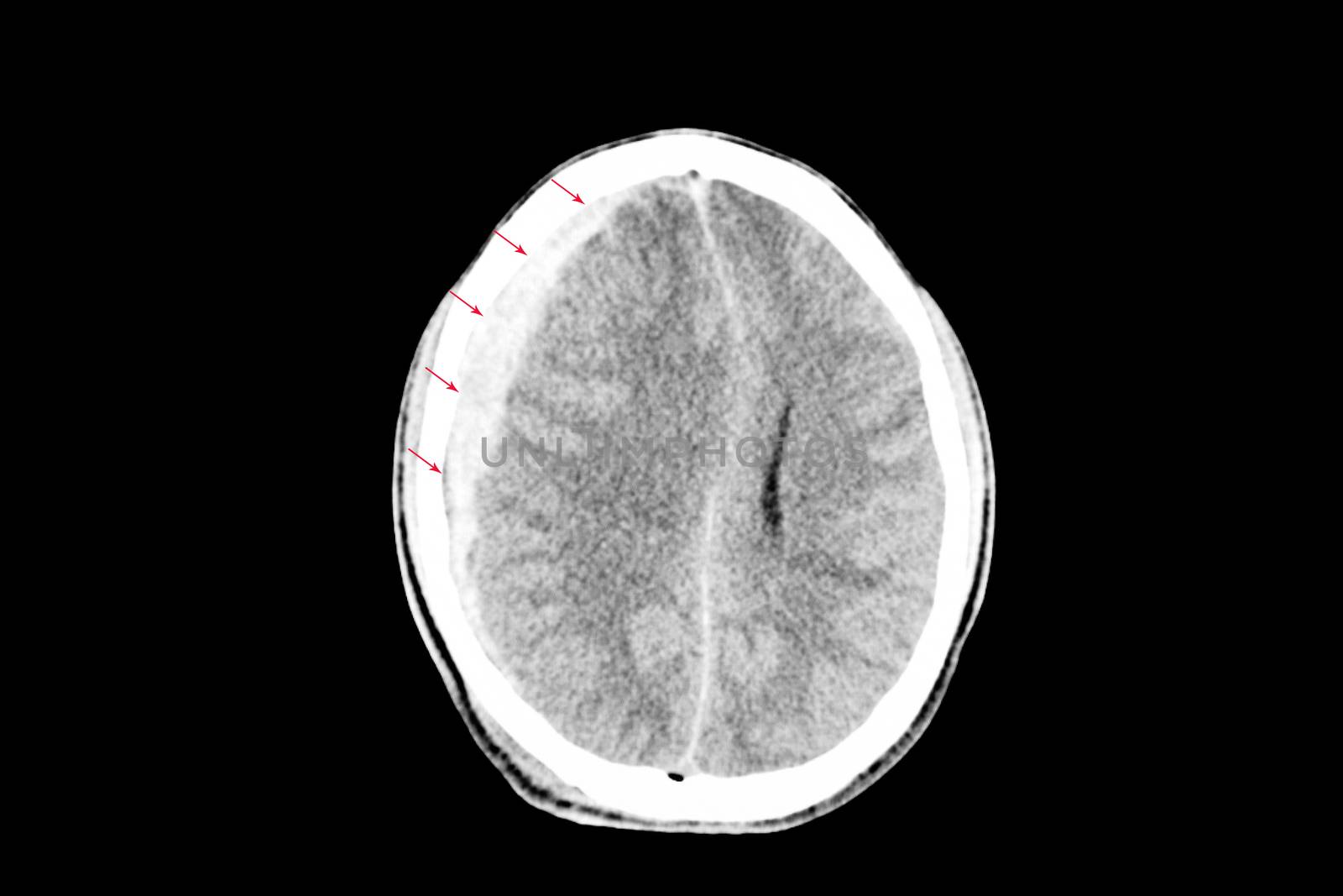 a brain CT scan of a patient with traumatic brain injury showing right subdural hemorrhage and brain edema with shifting of falx cerebri to the left