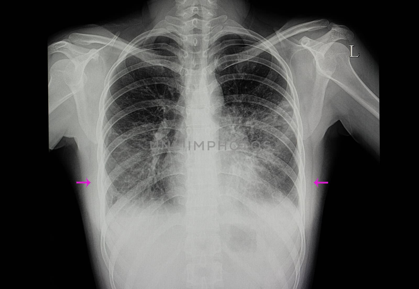 a chest xray film of a patient with bilateral lower lungs pneumonia