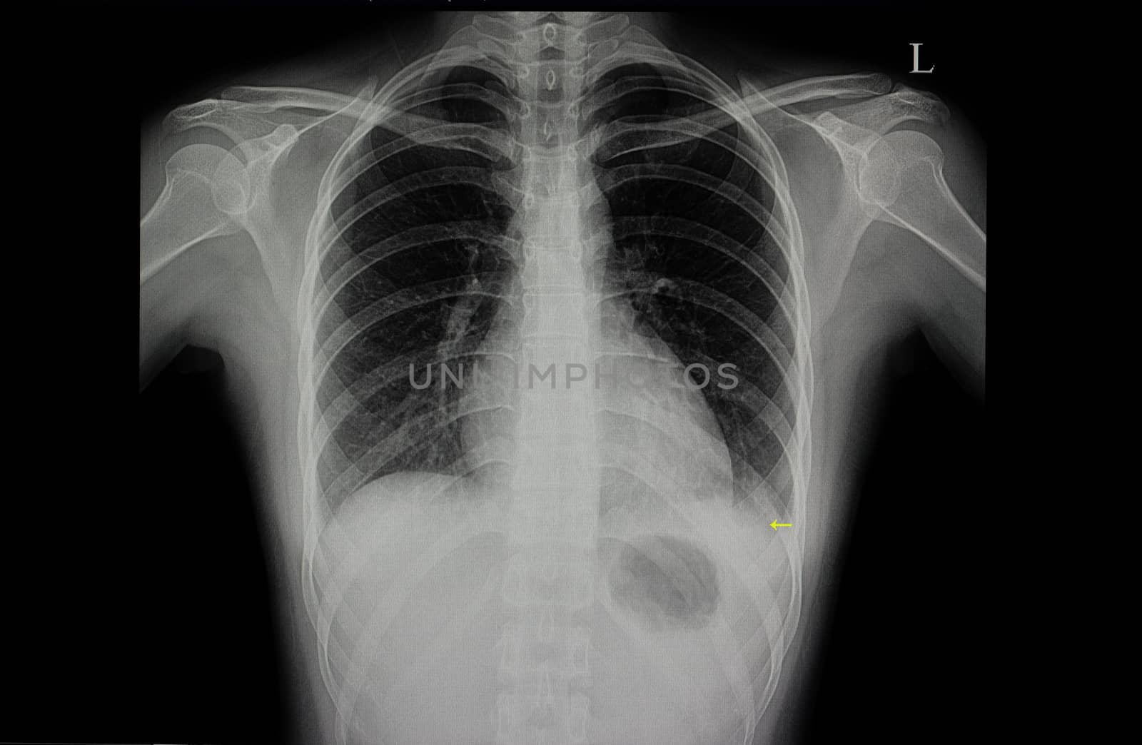A chest xray film of a patient with left lower lung pneumonia.